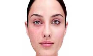 Купероз: современные методы лечения