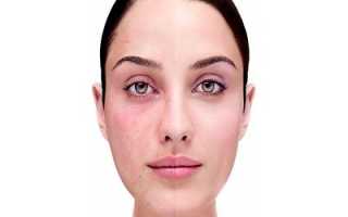 Купероз: современные методы лечения