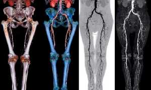 Диагностика заболеваний сосудов нижних конечностей при помощи ангиографии