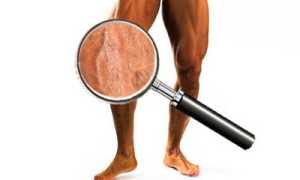 Варикозная болезнь у мужчин: причины, клиника и доступные методы лечения