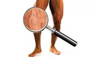 Варикозная болезнь у мужчин: причины, клиника и доступные методы лечения