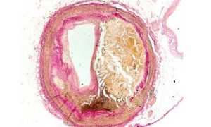Сужение церебральных сосудов: причины, клиника, методы терапии