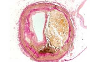 Сужение церебральных сосудов: причины, клиника, методы терапии