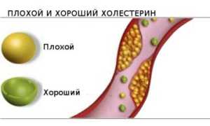 Определение холестерина посредством липидограммы
