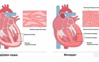 Симптомы, диагностика и лечение кардиосклероза
