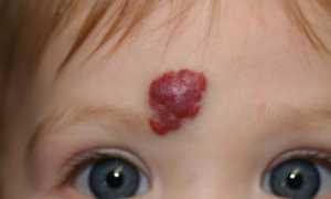 Гемангиома: причины развития, виды, особенности диагностики и лечения