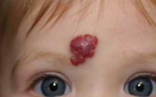 Гемангиома: причины развития, виды, особенности диагностики и лечения