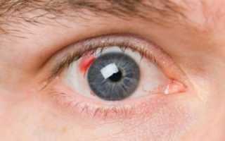 Ретинопатия: причины, виды, симптомы, основы диагностики и лечения