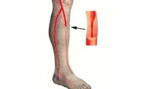 Окклюзия сосудов ног: причины, клиническая картина и лечение патологии