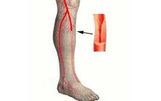 Окклюзия сосудов ног: причины, клиническая картина и лечение патологии
