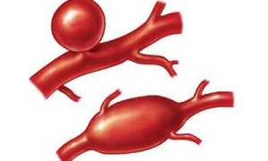 Причины возникновения и лечение аневризматических образований сосудов