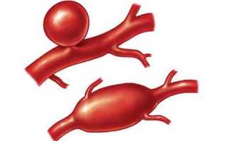 Причины возникновения и лечение аневризматических образований сосудов