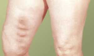 Тромбирование сосудов ног: развитие и риски патологии