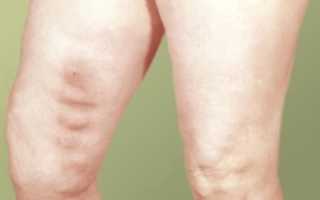 Тромбирование сосудов ног: развитие и риски патологии