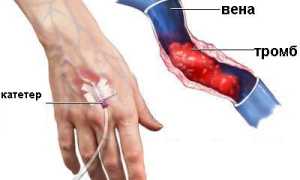 Все, что необходимо знать о тромбозе вен