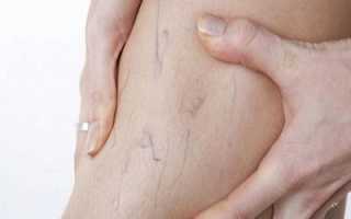 Характеристика, проявления и терапия ретикулярного варикоза