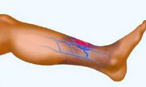 Эндартериит: этиология, патогенез и симптомы заболевания