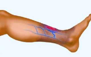 Эндартериит: этиология, патогенез и симптомы заболевания