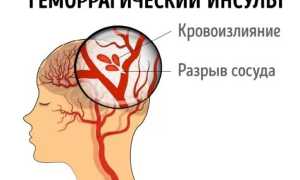Что представляет собой геморрагический инсульт?