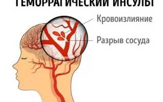 Что представляет собой геморрагический инсульт?