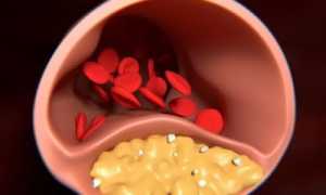 Развитие и терапия рассеянной формы атеросклероза