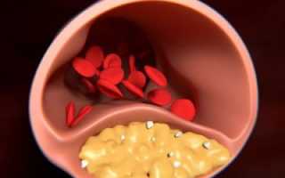 Развитие и терапия рассеянной формы атеросклероза