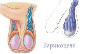 Варикоцеле и киста яичка: в чем разница?