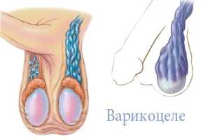 Варикоцеле и киста яичка: в чем разница?