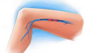 Проявления тромбофлебита