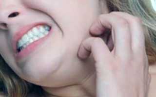 Найз в лечении головных болей