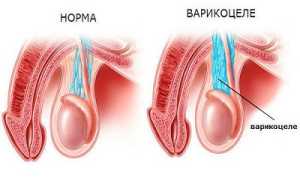 Какие степени варикоцеле существуют?
