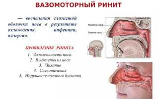 Вазомоторный хронический ринит: симптомы и лечение в домашних условиях