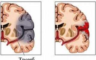 Какие виды инсульт-патологий существуют?