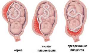 Предлежание плаценты (краевое, низкое, полное)