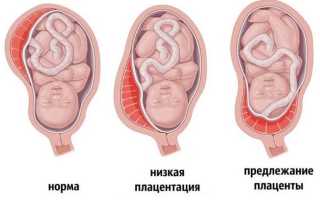 Предлежание плаценты (краевое, низкое, полное)