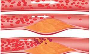 Особенности атеросклероза, развивающегося в брахиоцефальных артериях