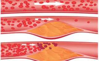 Особенности атеросклероза, развивающегося в брахиоцефальных артериях