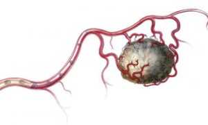 Классификация, причины возникновения и клиническая картина при окклюзии кровеносных сосудов