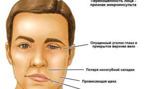 Симптоматика микроинсульта