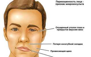 Симптоматика микроинсульта