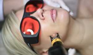 Удаление сосудистых звездочек с помощью лазера: особенности процедуры