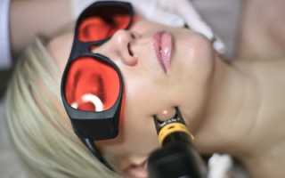 Удаление сосудистых звездочек с помощью лазера: особенности процедуры