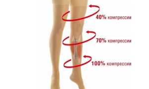 Колготки – эффективное средство профилактики и лечения варикоза
