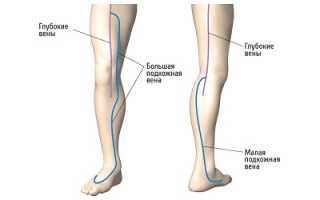 Распространенные сосудистые заболевания нижних конечностей