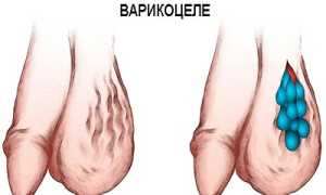Виды хирургических операций при варикоцеле: преимущества и особенности проведения