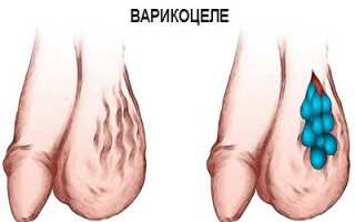 Виды хирургических операций при варикоцеле: преимущества и особенности проведения
