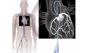 Коронарография – основной метод диагностики ИБС