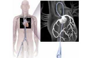 Коронарография – основной метод диагностики ИБС