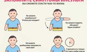 В деталях, о состоянии обширного инсульта