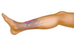 Как залечивать язвы на ногах при варикозе?